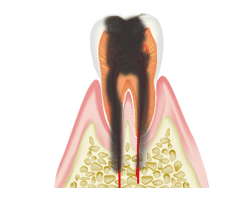 虫歯レベル4