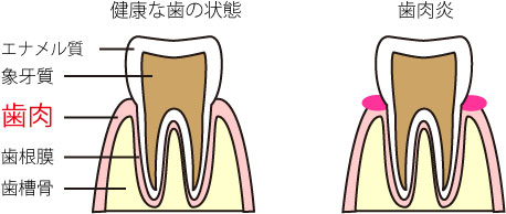 歯肉炎（しにくえん）