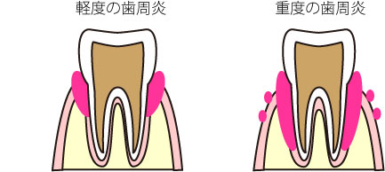 歯周炎（ししゅうえん）