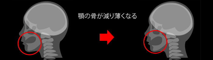 薄くなる顎の骨